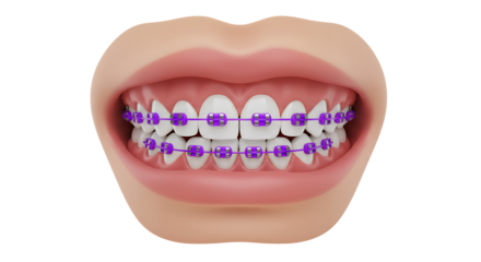 Understanding Braces and Their Role in Dental Correction and Aesthetics