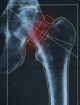 Bone density diagnostics of the femur of an elderly woman with severe osteoporosis, medical examination