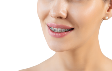 Closeup Metal Brackets on Teeth. Orthodontic Dental. Woman Healthy Smile. Female Smile with Braces. Close up of white teeth with braces. Dental care and treatment. Girl smile with Braces accessories
