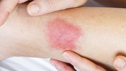 allergic reaction to an insect bite. Allergy to wasp and mosquito bites