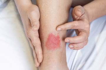 allergic reaction to an insect bite. Allergy to wasp and mosquito bites