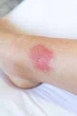 allergic reaction to an insect bite. Allergy to wasp and mosquito bites