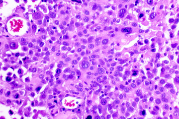 Backgrounds of human cells tissue of lung human under the microscope in pathology lab.View in...