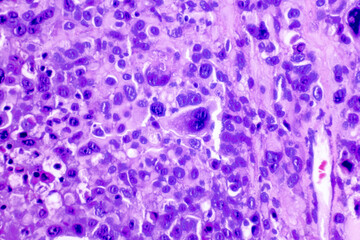 Backgrounds of human cells tissue of lung human under the microscope in pathology lab.View in microscopic of squamous cell carcinoma from human cervical cancer, tissue section by H and E