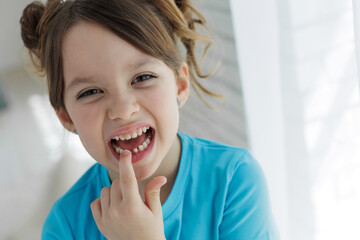 Loss baby teeth. Baby teeth have to fall out to make way for permanent teeth to grow. Girl showing...