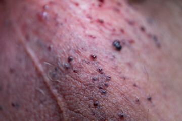 Angiokeratomas of the scrotum (Fordyce angiokeratomas), red-to-violaceous papules composed of dilated dermal capillariesrated image
