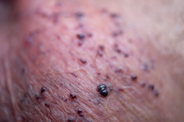 Angiokeratomas of the scrotum (Fordyce angiokeratomas), red-to-violaceous papules composed of dilated dermal capillaries