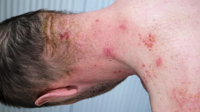 Skin lesion symptom in Shingles or Herpes zoster in person. Viral disease Varicella virus. Painful skin rash with blisters on the body. Red pimples. Insects bite. Body injury. High quality 4k footage.