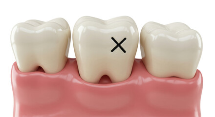 Isolated Decayed Tooth with Cross Mark