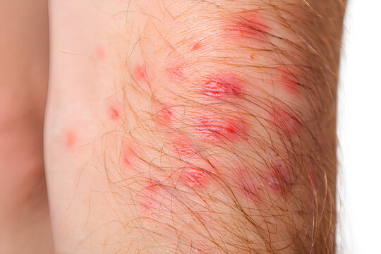 Caucasian man’s leg with clusters of flea bites, red and inflamed skin, hair-covered area with multiple raised itchy welts, realistic close-up for health, allergy, or dermatological awareness material