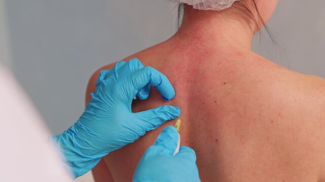 carboxytherapy. hardware injections into the patient's back. beauty and health