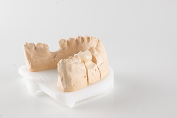 dental crown made of ceramics