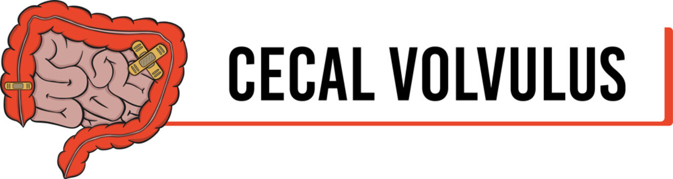 cecal volvulus