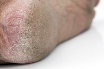 Cracked Heels: Close-up of a severely cracked heel, highlighting the dry, damaged skin and...
