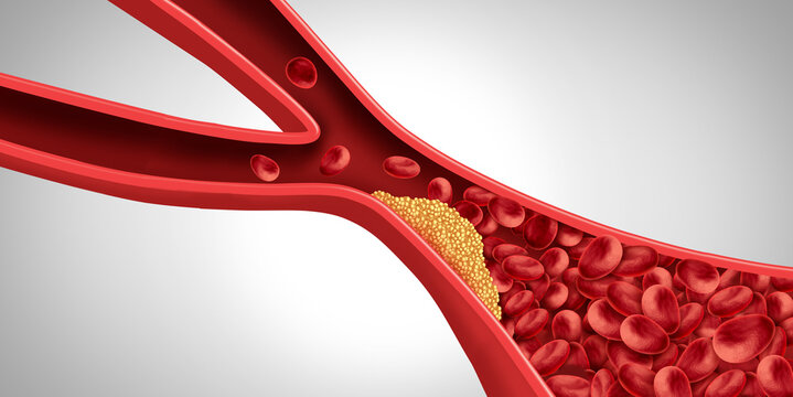 Artery Plaque causing Mini Strokes and Ministroke or transient ischemic attack as TIA stroke as blood flow in the brain blocked or heart attack as a blood clot buildup as Atherosclerosis or Emboli.