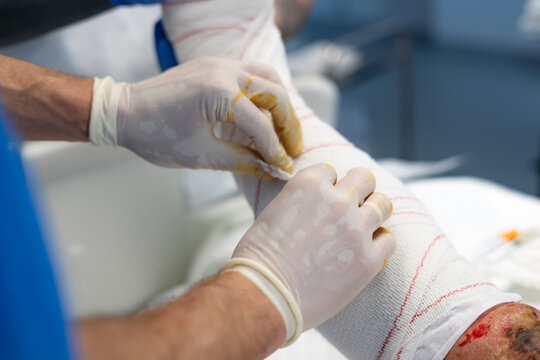 Doctors applying bandage on injured leg in operating room