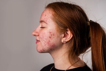 Many pimples. Girl with bad skin. Hormonal acne, puberty. Skin acne background. Closeup acne pimple. Treatment for acne skin. Problem skincare. Pimples, pores, scars. Skincare treatment