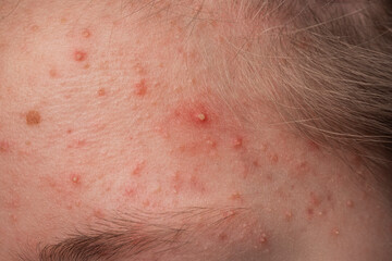 Pimple acne. Skin texture background. Closeup acne pimple. Problem skincare. Pimples, acne, pores,...