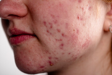Pimple closeup. Skin texture. Closeup acne skin. Treatment for skin. Problem skincare. Acne...