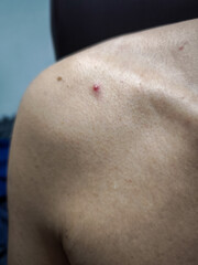 pimple on shoulder