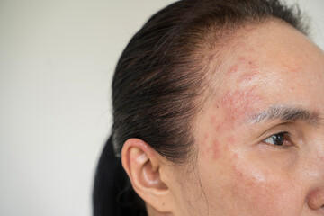 Beautiful attractive girl lying on bed in bedroom suffering from itching arm skin allergic reaction