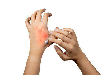 Eczema dermatitis on hands. red spots on the skin. dry skin The concept dermatology, treatment...