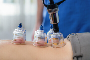 Woman receiving cupping therapy on her back during a physical therapy session. The suction cups...