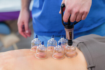 Woman receiving cupping therapy on her back during a physical therapy session. The suction cups...