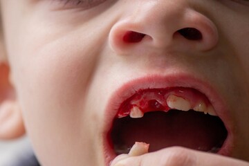 A child has lost a baby tooth. Kid.Concept baby tooth