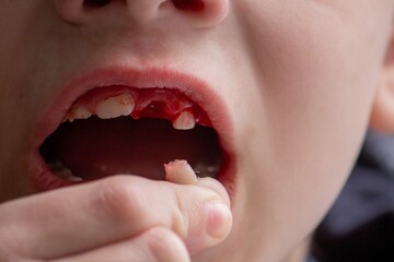A child has lost a baby tooth. Kid.Concept baby tooth