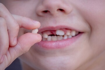 A child has lost a baby tooth. Kid.Concept baby tooth