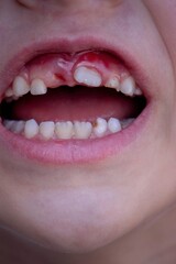 Close-up of unhealthy baby teeth. Sick teeth in a child. Portrait of a boy with sick teeth