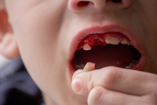 A child has lost a baby tooth. Kid.Concept baby tooth