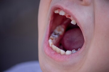 Close-up of unhealthy baby teeth. Sick teeth in a child. Portrait of a boy with sick teeth