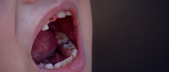 Close-up of unhealthy baby teeth. Sick teeth in a child. Portrait of a boy with sick teeth