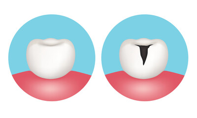 Tooth with and without caries. Anatomy of the tooth. Vector illustration.