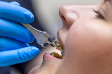 Dental procedure for installing braces close up. Dentistry. Braces on the teeth.