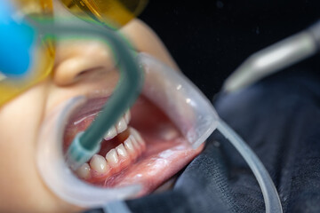 Obraz premium Close-up of a child's mouth during dental treatment. Dentistry. Dental treatment.