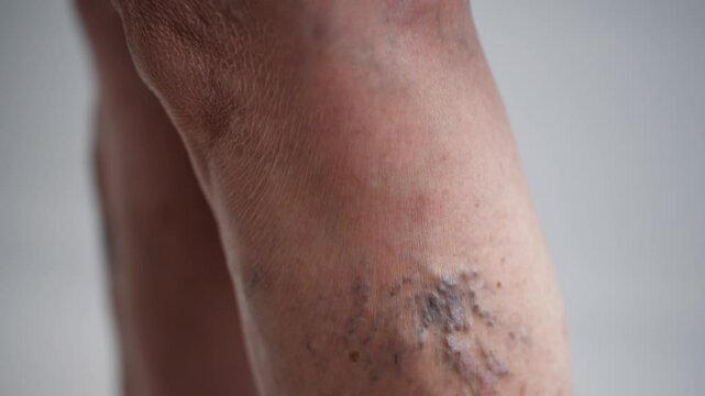 Swollen Varicose Veins on Female Legs