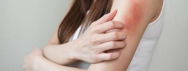 Close-up of young woman scratch her arm have a red rash