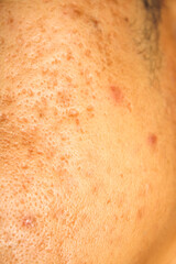 Fototapeta premium Close-Up of Human Skin Showing Acne and Pore Variations