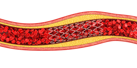Medical illustration showing balloon angioplasty and stent insertion. 3d illustration