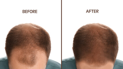 Baldness. Closeup view of man before and after treatment on white background, collage