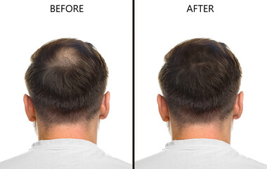Man suffering from baldness on white background, back view. Collage with photos before and after...