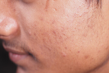 Fototapeta premium Close-up of skin with acne scars in natural light