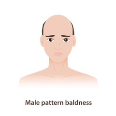 Male pattern baldness is hair problems for men illustration on white background. Androgenetic alopecia is a type of hair loss, often stemming from genetics and hormone dihydrotestosterone, DHT.