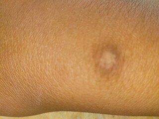 A person with a rash