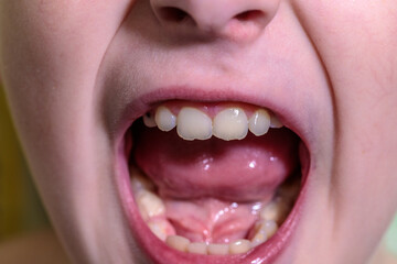 ten year old boy screaming menacingly with mouth wide open. close up part of face