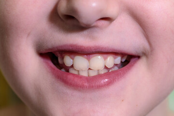 Ten year old boy's wide smile. close-up of part of face