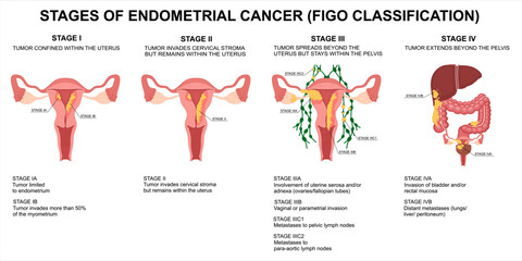 Endometrial cancer stages. FIGO classification of uterine cancer